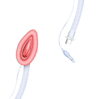 Silicone Laryngeal Mask airway management device