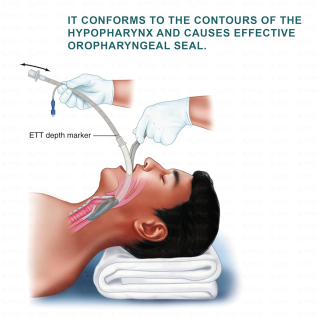 Laryngeal Mask airway management device for surgery