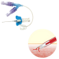 Safety Closed I.V. Catheter System – Polymed Nouvo Safety Set for Sterile Infusion and Professional IV Administration