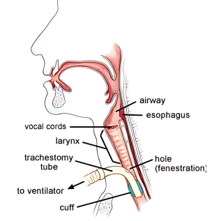 Tracheostomy Tubes BLUselect Cuffed