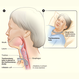 Tracheostomy Tubes BLUselect Cuffed