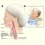 Tracheostomy Tubes BLUselect Cuffed