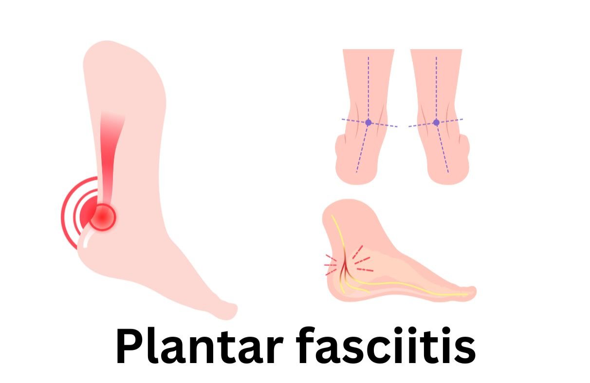 Plantar Fasciitis: The Complete Guide to Symptoms, Causes, Treatments, and Prevention