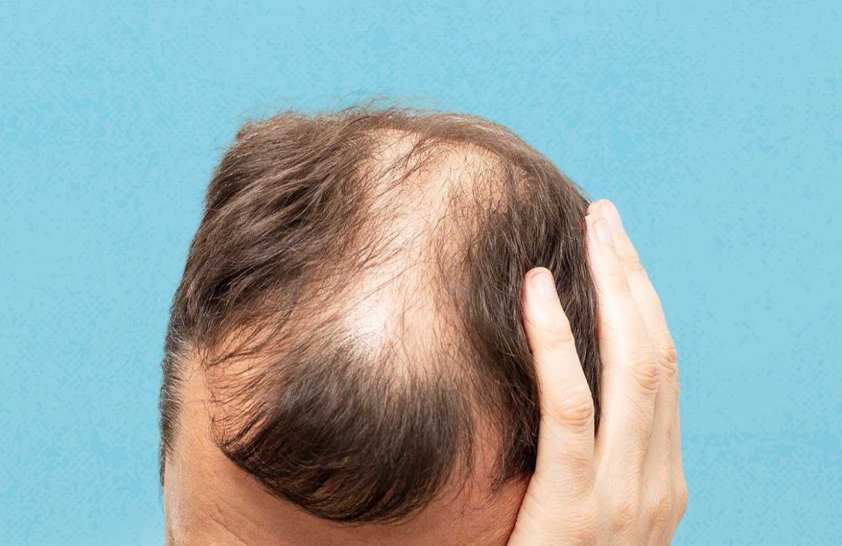 Hairloss reasons and prevention